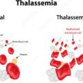 Beta Thalassemia, Thalassemia, Genetic disorder, Genetic counseling, Thalassemia screening